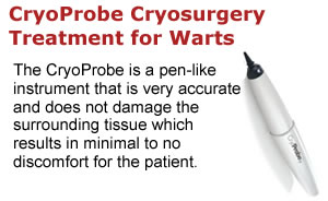 CryoPen for Wart Removal