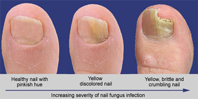 Laser treatment for toenail deals fungus near me